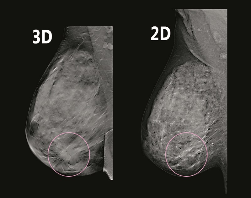 مزایای ماموگرافی 3 بعدی 