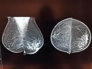تصاویر ماموگرافی دیجیتال با دستگاه هالوژیک