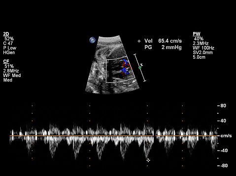 Fetal heart echocardiography