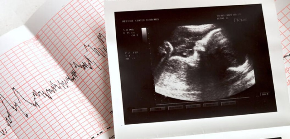 m/ غربالگری اول جنین