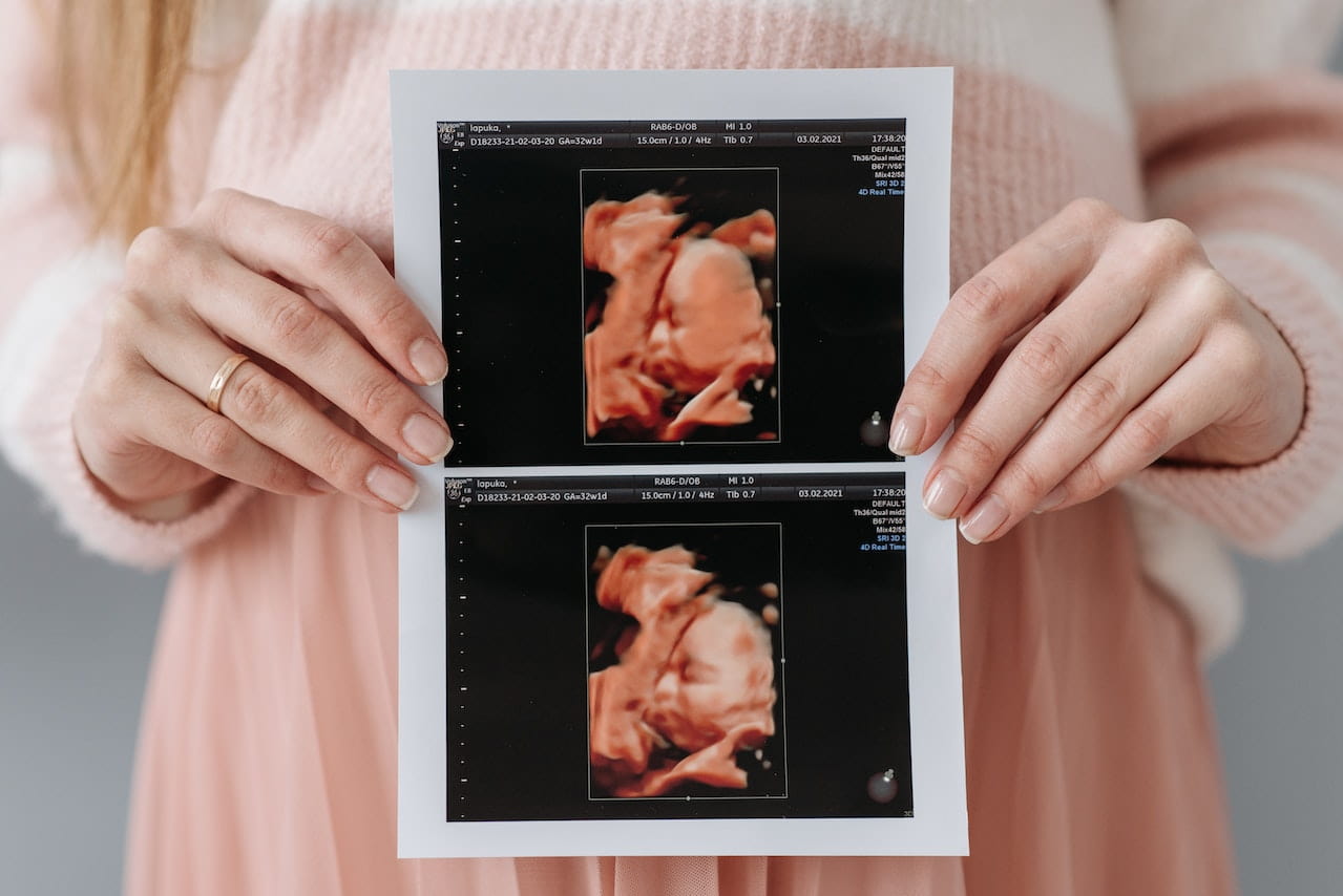 انواع سونوگرافی در زمان بارداری