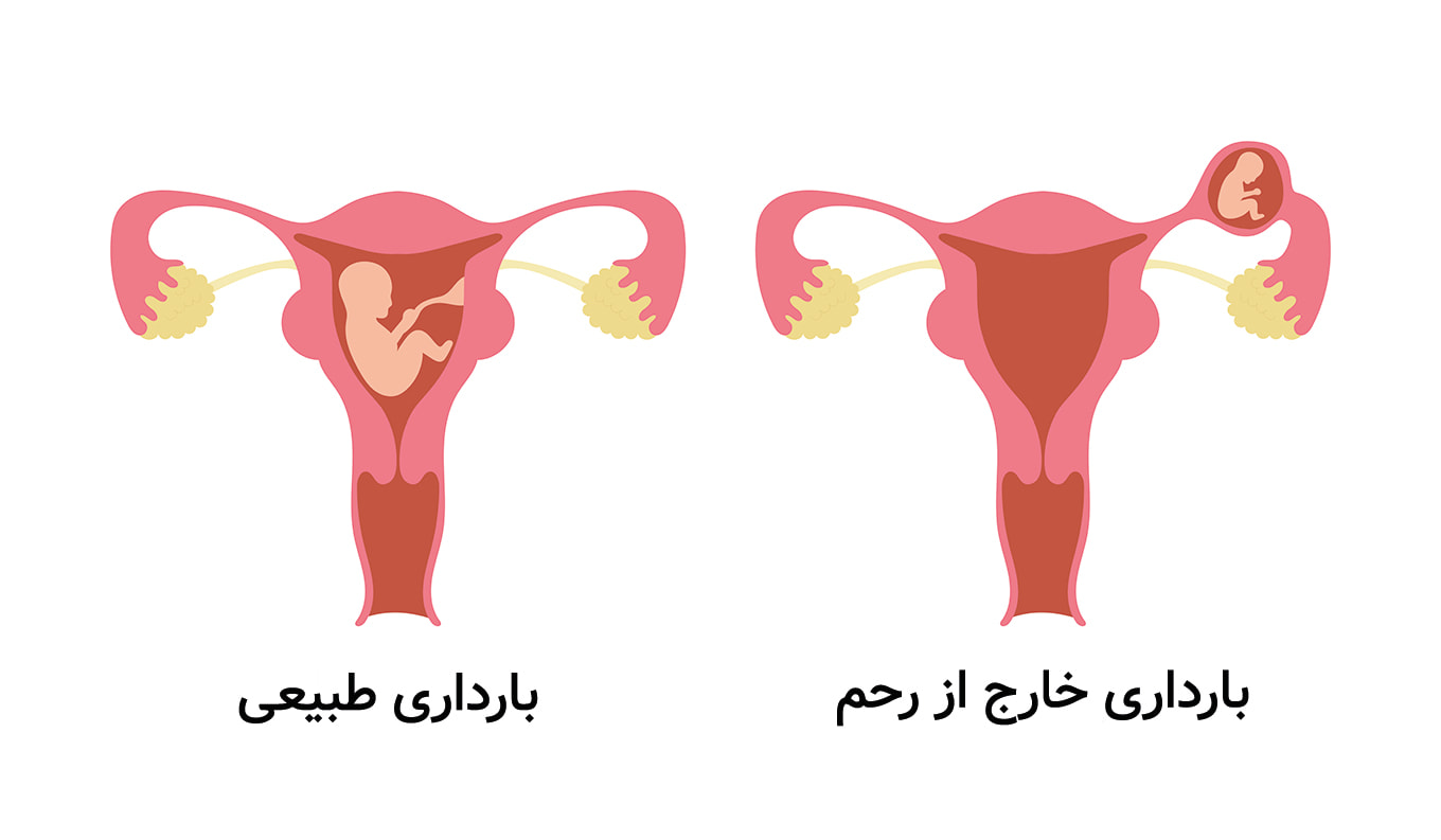 m/ بارداری خارج از رحم