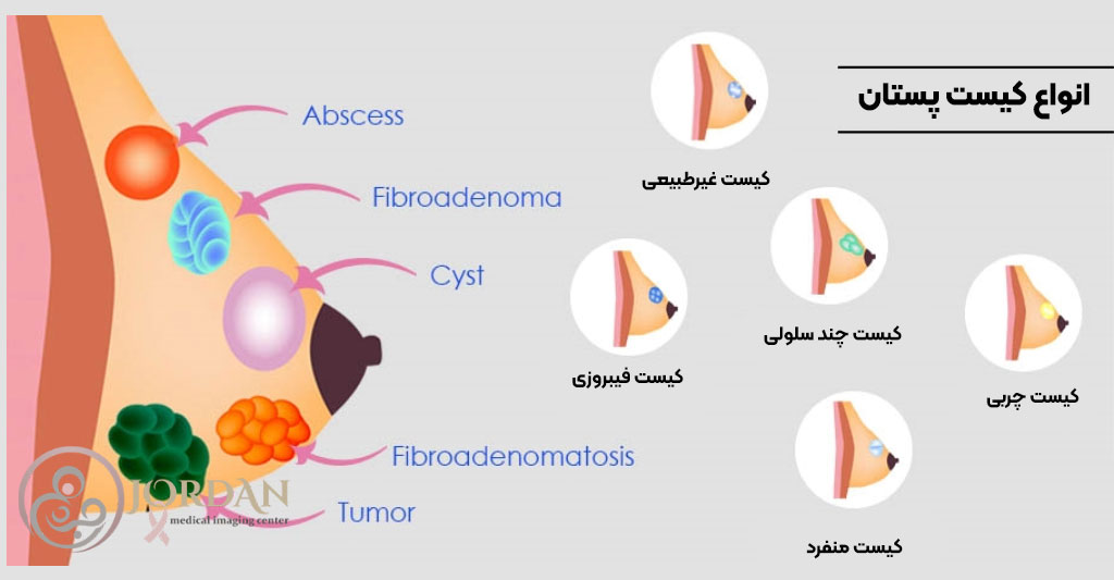 سونوگرافی کالر داپلر در ارزیابی توده‌های سینه