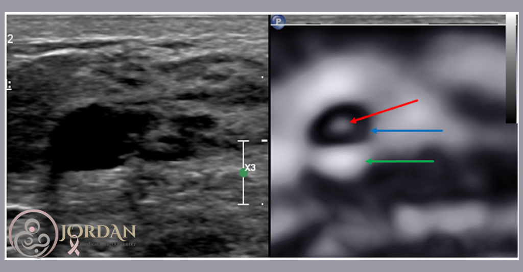 کاربردهای الاستوگرافی پستان در تشخیص توده های سرطانی