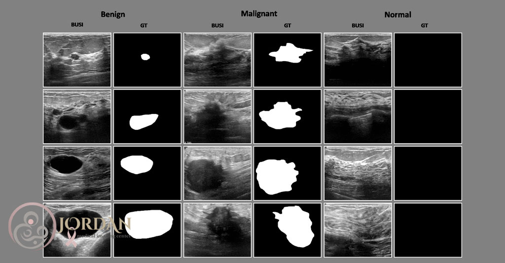 شناسایی توده های سینه با سونوگرافی