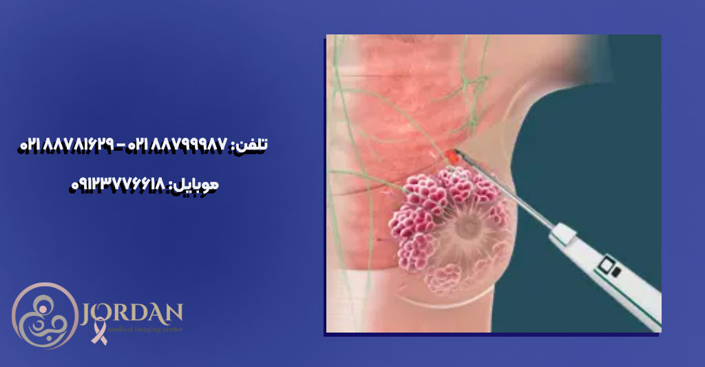 بهترین مرکز نمونه برداری از پستان در تهران