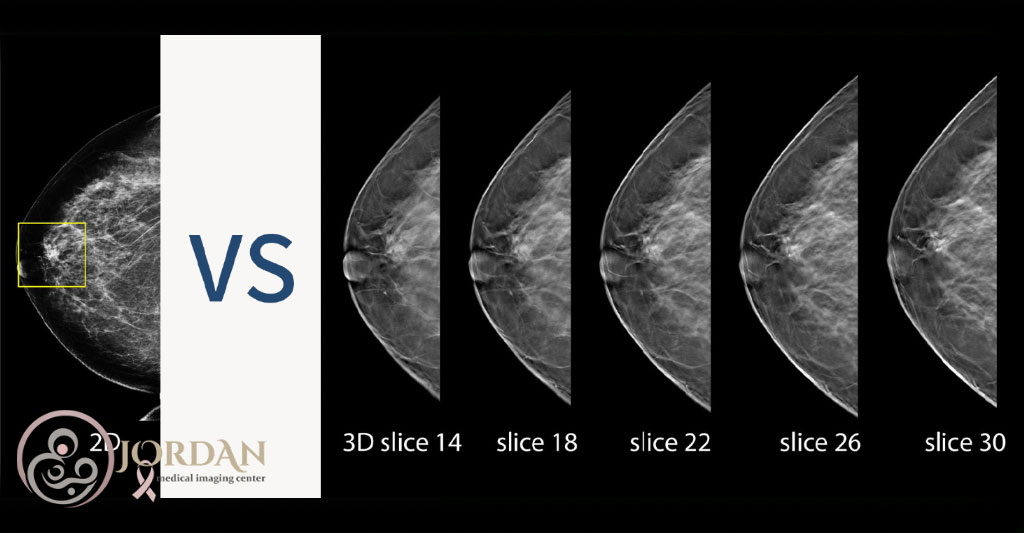 تفاوت ماموگرافی توموسنتزیس و سنتی